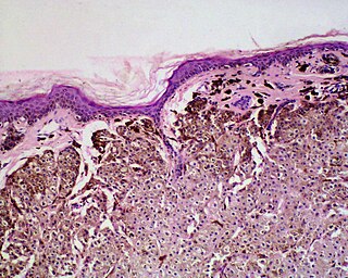 <span class="mw-page-title-main">Balloon cell nevus</span> Medical condition