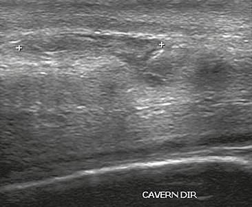 Ultrasonography of ruptured tunica albuginea.jpg