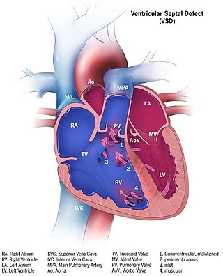 <span class="mw-page-title-main">Ventricular septal defect</span> Medical condition