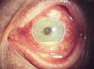 <span class="mw-page-title-main">Behçet's disease</span> Inflammatory disorder