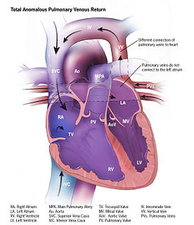 Anomalous pulmonary venous connection Medical condition