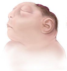 Anencephaly-web.jpg