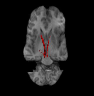 <span class="mw-page-title-main">Nigrostriatal pathway</span> Bilateral pathway in the brain