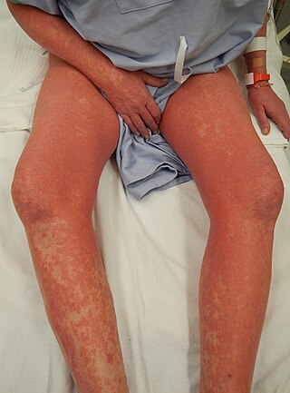 <span class="mw-page-title-main">Sézary disease</span> Medical condition