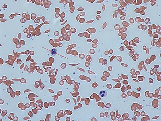 <span class="mw-page-title-main">Hemoglobinopathy</span> Any of various genetic disorders of blood