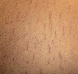 <span class="mw-page-title-main">Stretch marks</span> Form of scarring