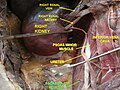 Psoas major muscle