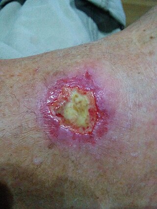 <span class="mw-page-title-main">Livedoid vasculopathy</span> Blood vessel disorder causing ulcers in the lower limbs