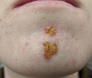 Impetigo Human disease (bacterial infection)