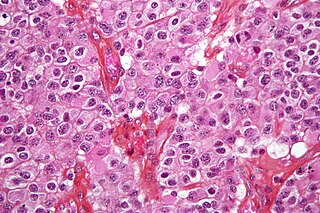 <span class="mw-page-title-main">Oligodendroglioma</span> Medical condition