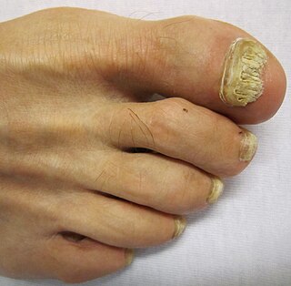 <span class="mw-page-title-main">Onychomycosis</span> Medical condition