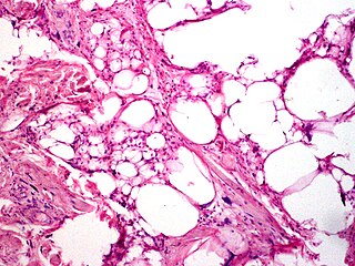 <span class="mw-page-title-main">Pleomorphic lipoma</span> Medical condition