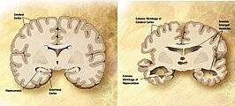 Vergelijking van normale hersenen (links) met die van een alzheimerpatiënt (rechts).