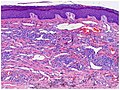 Micrograph of plaque stage, with bizarre vessels dissecting the upper dermis. There is erythrocyte extravasation and hemosiderin pigmentation.[16]