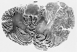 <span class="mw-page-title-main">Ganglioglioma</span> Medical condition