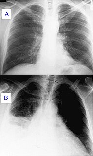 Pulmonary consolidation Medical condition