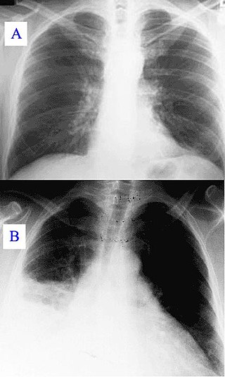 <span class="mw-page-title-main">Ventilator-associated pneumonia</span> Pneumonia due to use of ventilator