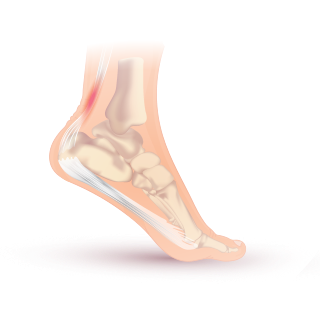 <span class="mw-page-title-main">Achilles tendinitis</span> Medical condition of the ankle and heel