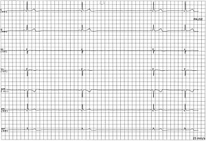 ECG Sinus Pause.jpg