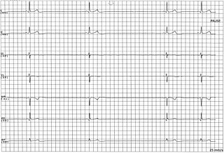 <span class="mw-page-title-main">Sinus node dysfunction</span> Medical condition