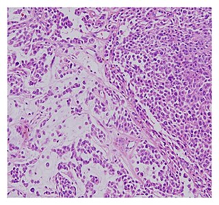 Malignant chondroid syringoma Type of skin cancer