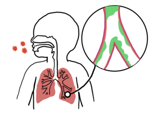 <span class="mw-page-title-main">Bronchiolitis</span> Inflammation of the small airways in the lungs