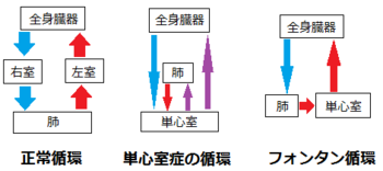 正常循環・単心室症の循環・フォンタン循環の図解例。赤は動脈血（酸素化血）、青は静脈血（脱酸素化血）、紫はチアノーゼを表す。