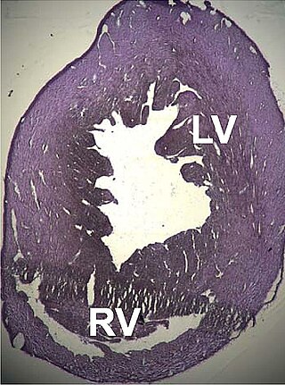 <span class="mw-page-title-main">Dilated cardiomyopathy</span> Condition involving an enlarged, ineffective heart