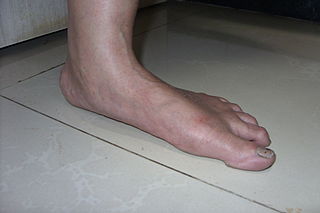 <span class="mw-page-title-main">Diseases of the foot</span>