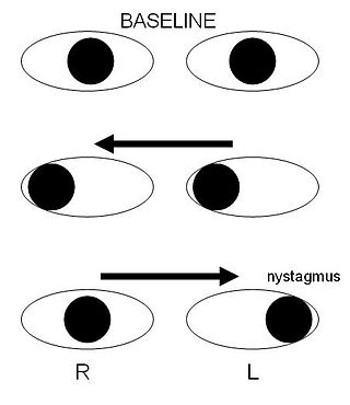 <span class="mw-page-title-main">Internuclear ophthalmoplegia</span> Medical condition