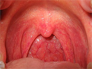 Pharyngitis Medical condition