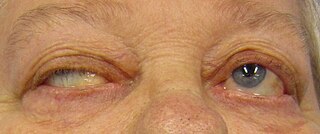 <span class="mw-page-title-main">Myasthenia gravis</span> Autoimmune disease resulting in skeletal muscle weakness