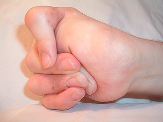 <span class="mw-page-title-main">Freeman–Sheldon syndrome</span> Rare congenital disorder