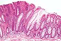 Precancer – Tubular adenoma (left of image), a type of colonic polyp and a precursor of colorectal cancer. Normal colorectal mucosa is seen on the right.