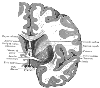 <span class="mw-page-title-main">Commissural fiber</span> Axons that connect the two hemispheres of the brain