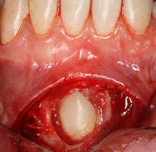 <span class="mw-page-title-main">Tooth impaction</span> Prevention of tooth eruption by a physical barrier