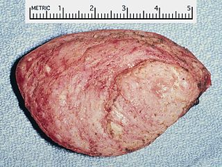 <span class="mw-page-title-main">Rhabdomyoma</span> Medical condition