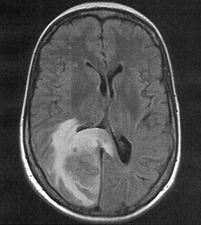 <span class="mw-page-title-main">Cerebral edema</span> Excess accumulation of fluid (edema) in the intracellular or extracellular spaces of the brain