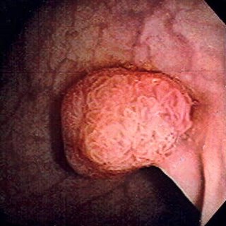 Colorectal polyp Medical condition