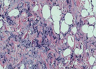 <span class="mw-page-title-main">Spindle cell lipoma</span> Medical condition