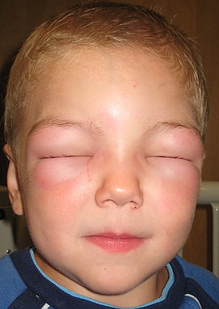 <span class="mw-page-title-main">Angioedema</span> Disease characterized by rapid swelling