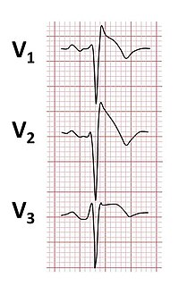 Brugada syndrome Heart conduction disease