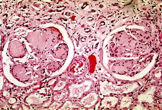 <span class="mw-page-title-main">Diabetic nephropathy</span> Chronic loss of kidney function