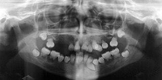 <span class="mw-page-title-main">Dentin dysplasia</span> Medical condition