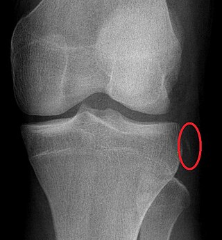 <span class="mw-page-title-main">Segond fracture</span> Avulsion fracture of the lateral tibial condyle of the knee