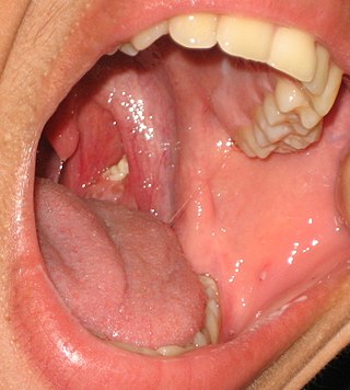 <span class="mw-page-title-main">Tonsil stones</span> Mineralized debris within the crevices of the tonsils