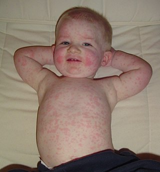 <span class="mw-page-title-main">Fifth disease</span> Red rash due to infection with parvovirus B19