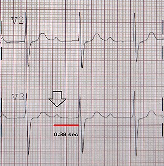 <span class="mw-page-title-main">First-degree atrioventricular block</span> Medical condition