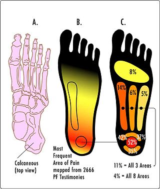 <span class="mw-page-title-main">Plantar fasciitis</span> Connective tissue disorder of the heel