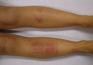 <span class="mw-page-title-main">Erythema nodosum</span> Medical condition